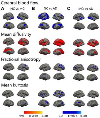 The correlation between changes in gray matter microstructure and cerebral blood flow in Alzheimer’s disease